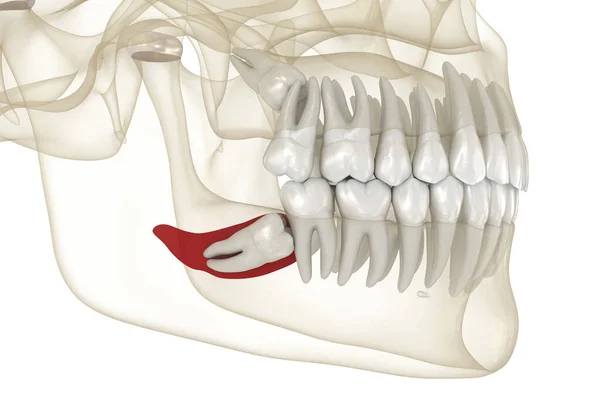 知恵の歯と骨の炎症の間質の影響 医学的に正確な歯3Dイラスト — ストック写真
