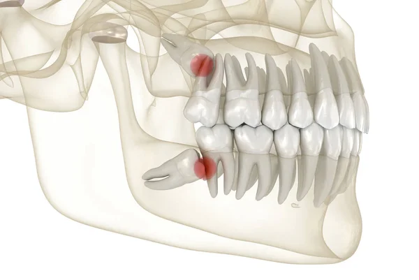 智齿对第二磨牙的微小影响 医学上准确的牙齿3D图像 — 图库照片