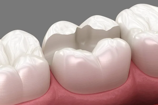 磨牙为陶瓷嵌入物的放置准备 医学上准确的人类牙齿治疗三维图像 — 图库照片