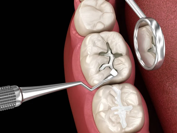 Bileşik Dolgusu Olan Çürük Diş Restorasyonu Diş Illüstrasyon — Stok fotoğraf