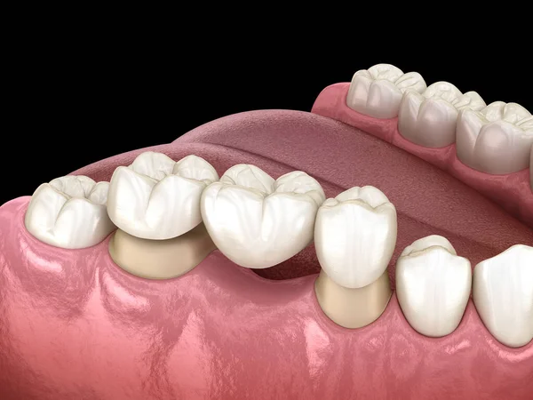 Molaire Premolaire Tand Tandheelkundige Brug Plaatsing Medisch Accurate Illustratie — Stockfoto