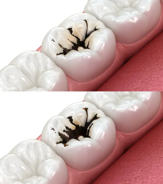 Molární Zub Progrese Caries Lékařsky Přesná Zubní Ilustrace — Stock fotografie