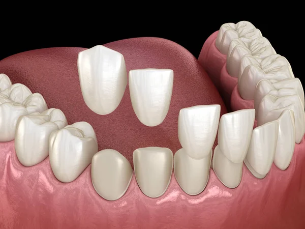 Процедура Розміщення Стоматологічного Шпону Стоматологічна Ілюстрація — стокове фото