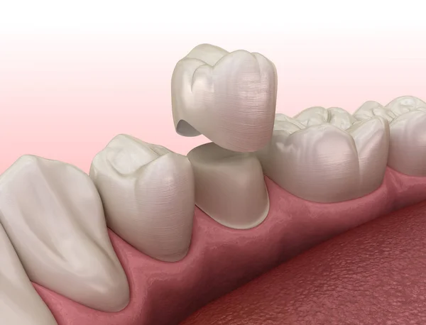 Colocación Dientes Premolares Corona Dental Preparada Ilustración Dental — Foto de Stock