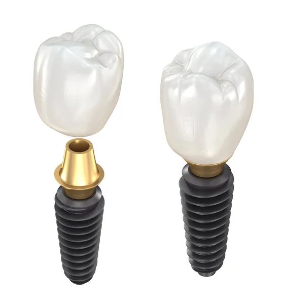 Diş Implantı Seramik Taç Tıbbi Olarak Doğru Diş Illüstrasyon — Stok fotoğraf