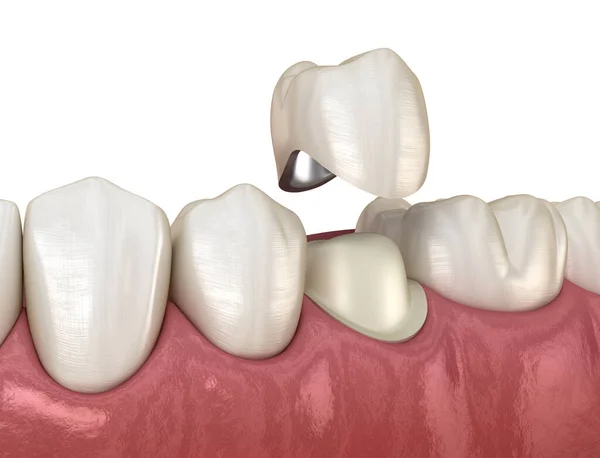 Preparated Premolar Tooth Dental Metal Ceramic Crown Medically Accurate Illustration — Stock Photo, Image