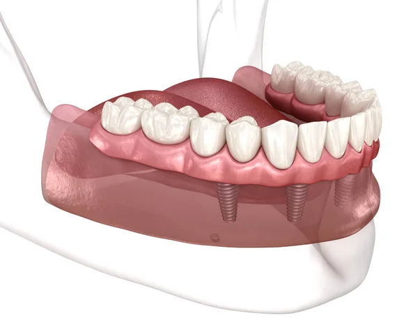 取り外し可能なプロテーゼインプラントでサポートされている4つのシステムのすべて 人間の歯と入れ歯の概念の医学的に正確な3Dイラスト — ストック写真