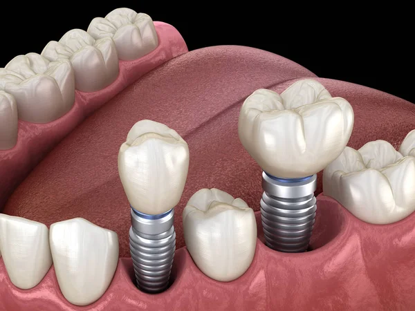 インプラント ネジ固定上の前歯と臼歯の歯冠のインストール 歯科治療の3Dイラスト — ストック写真