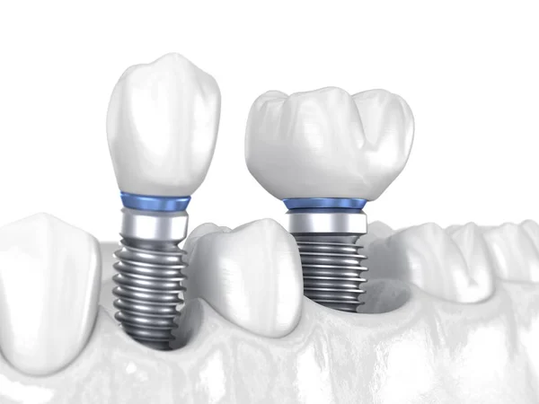 インプラント 白の概念上の前歯と臼歯の歯冠のインストール 人間の歯や入れ歯の3Dイラスト — ストック写真