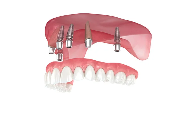 2本の歯と4本のインプラントによって支えられた上顎の義肢 歯科用3Dイラスト — ストック写真