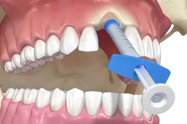 Увеличение Костной Трансплантации Сохранение Розеток Имплантация Зубов Медицинская Точность Иллюстрации — стоковое фото