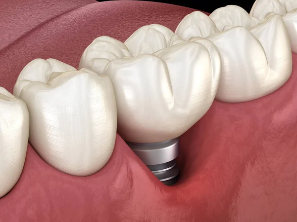 Perimplantitida Viditelnou Recesí Dásní Lékařsky Přesná Ilustrace Konceptu Zubních Implantátů — Stock fotografie