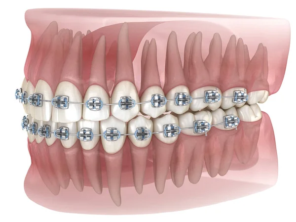 Metalowy Aparat Zęby Przezroczysty Model Medycznie Dokładna Ilustracja — Zdjęcie stockowe
