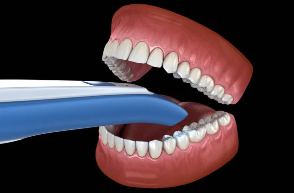 Dentes Intraorais Scanner Meu Próprio Projecto Dental Ilustração Conceito — Fotografia de Stock