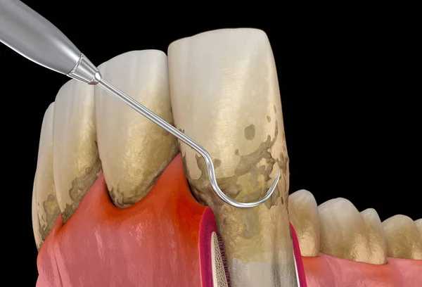 stock image Oral hygiene: Scaling and root planing (conventional periodontal therapy). Medically accurate 3D illustration of human teeth treatment