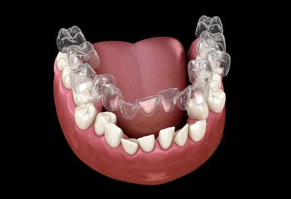Invisaligne Zahnspangen Oder Unsichtbare Halter Führen Zur Bisskorrektur Medizinisch Korrekte — Stockfoto