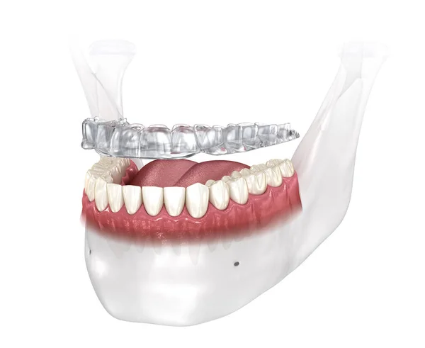 Férula Mordida Protección Contra Bruxismo Ilustración Dental Médicamente Precisa —  Fotos de Stock