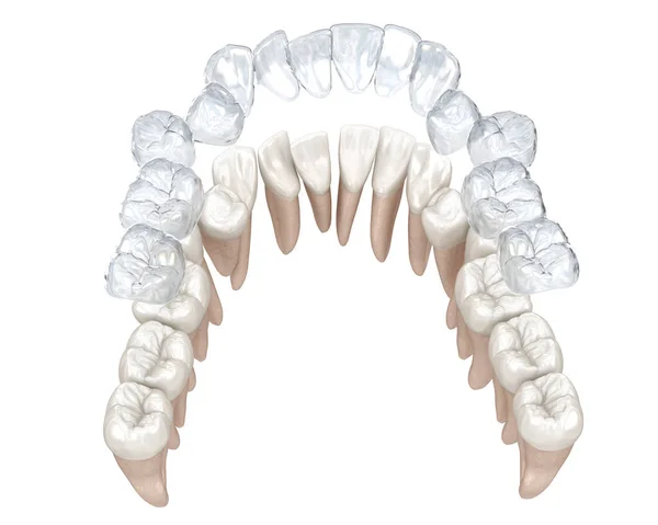 Diş Telleri Görünmez Diş Telleri Isırık Düzeltmesini Sağlar Tıbbi Olarak — Stok fotoğraf