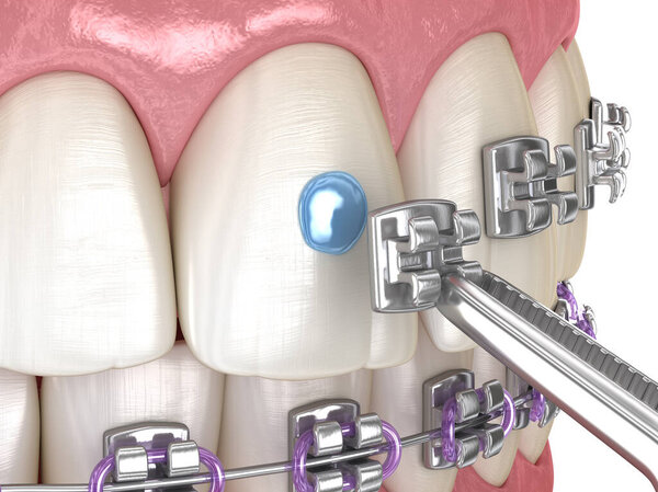 Metal braces installation process. Dental 3D illustration