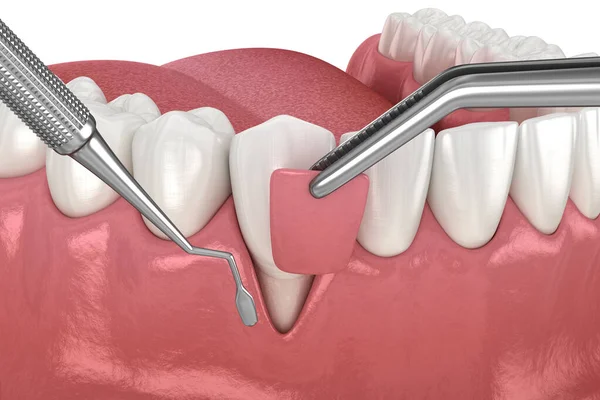 牙龈萎缩 软组织移植手术 牙科治疗的3D图解 — 图库照片