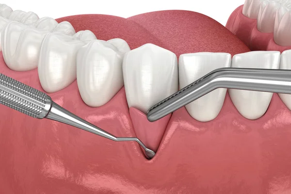 Sakız Resesyonu Yumuşak Doku Nakli Ameliyatı Diş Tedavisinin Boyutlu Illüstrasyonu — Stok fotoğraf