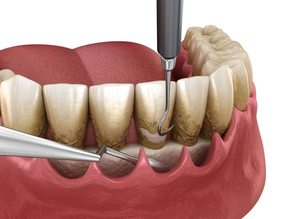 スケーリングと根計画 従来の歯周病治療 人間の歯の治療の医学的に正確な3Dイラスト — ストック写真