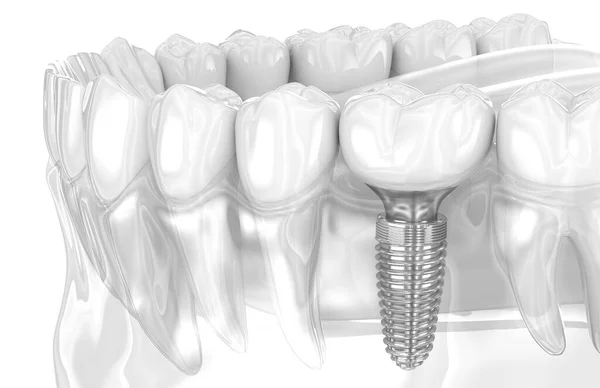 Οδοντιατρική Εμφύτευση Και Κεραμική Κορώνα Απεικόνιση Των Ανθρώπινων Δοντιών — Φωτογραφία Αρχείου