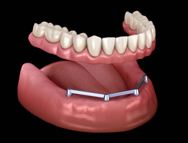 Çikletli çene protezi. Hepsi de implantlar tarafından desteklenen 4 sistemde. İnsan dişleri ve protez kavramının tıbben doğru üç boyutlu çizimi