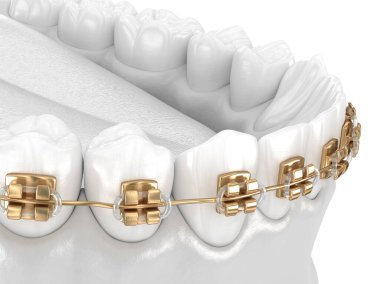 Healthy Teeth with gold braces, white style concept, dental 3D illustration clipart