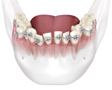Anormal diş pozisyonu ve metal diş telleriyle düzeltme. Tıbbi olarak doğru olan 3 boyutlu diş illüstrasyonu