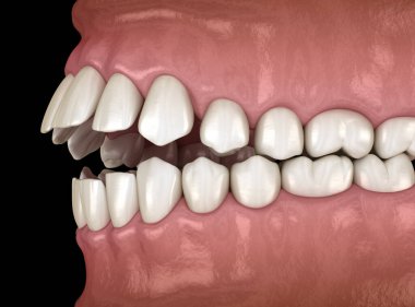 Açık diş tıkanıklığı (dişlerin Maloklüzyonu). Tıbbi olarak doğru diş 3D illüstrasyon