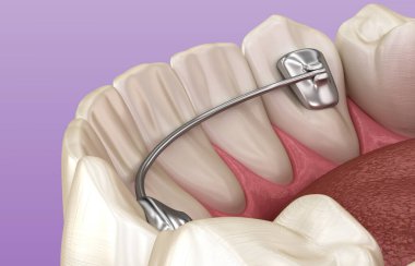 Diş tedaviden sonra takılan diş koruyucuları, tıbbi olarak doğru olan 3D illüstrasyon