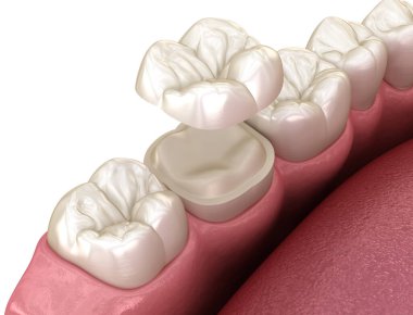 Diş üzerinde Onlay seramik taç fiksasyon. İnsan diş tedavisi tıbbi olarak doğru 3d illüstrasyon