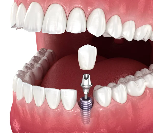Impianto Dentale Corona Ceramica Illustrazione Del Dente Clinicamente Accurata — Foto Stock