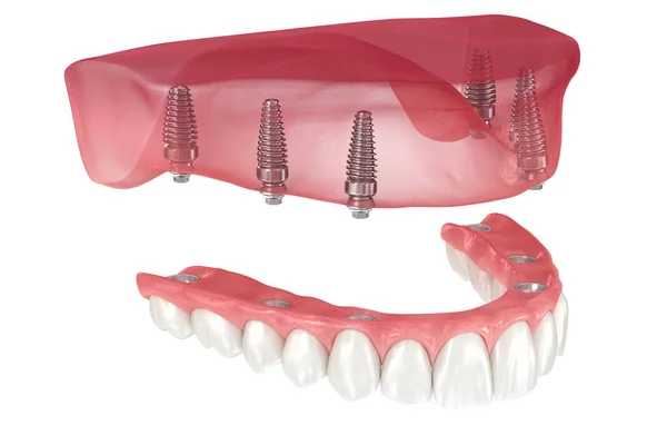 インプラントでサポートされている6つのシステム上のすべてのガムと上顎の義肢 歯科用3Dイラスト — ストック写真