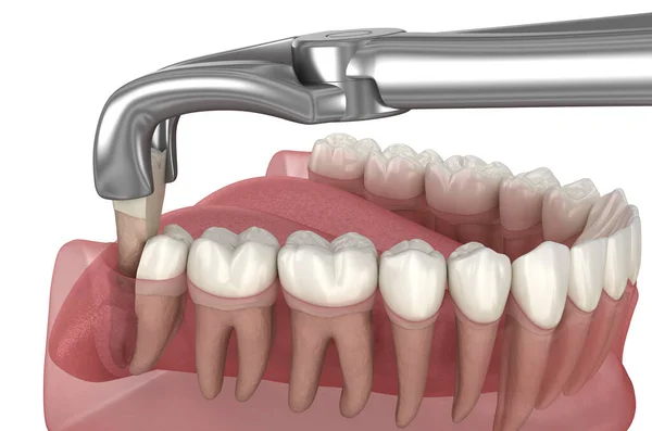 Yirmilik Dişinin Alınması Tıbbi Olarak Doğru Diş Illüstrasyon — Stok fotoğraf