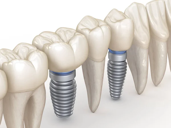 Οδοντιατρικά Εμφυτεύματα Και Δόντια Στη Σειρά Εικόνα Έννοια Των Ανθρώπινων — Φωτογραφία Αρχείου