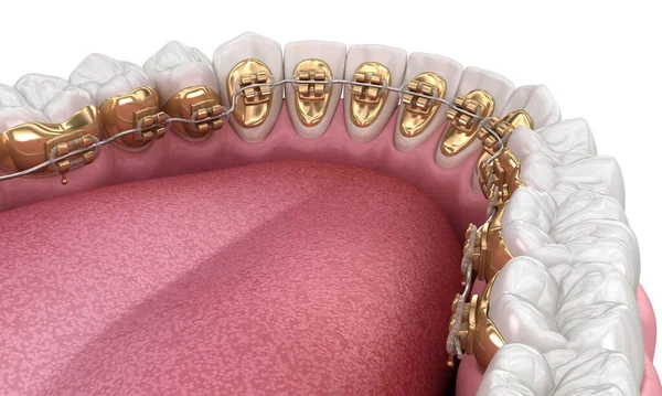 Здоровые Зубы Золотыми Брекетами Концепция Белого Стиля Стоматологическая Иллюстрация — стоковое фото