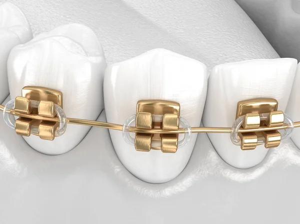 Zdravé Zuby Zlatými Rovnátky Koncept Bílého Stylu Zubní Ilustrace — Stock fotografie