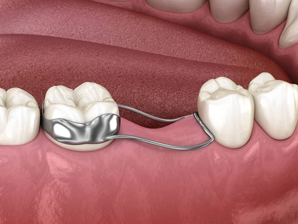 Підтримка Простору Односторонній Зберігає Деформацію Зубів Після Втрати Молярного Зуба — стокове фото