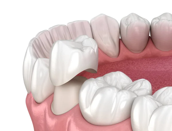 Przygotowany Ząb Przedtrzonowy Umieszczenie Korony Dentystycznej Medycznie Dokładna Ilustracja — Zdjęcie stockowe