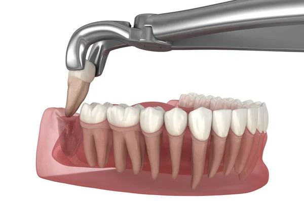 知恵の歯の抽出 医学的に正確な歯3Dイラスト ストックフォト