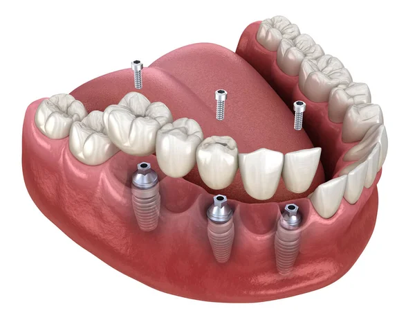 Zahnbrücke Auf Basis Von Implantaten Zahnärztliche Illustration Stockbild