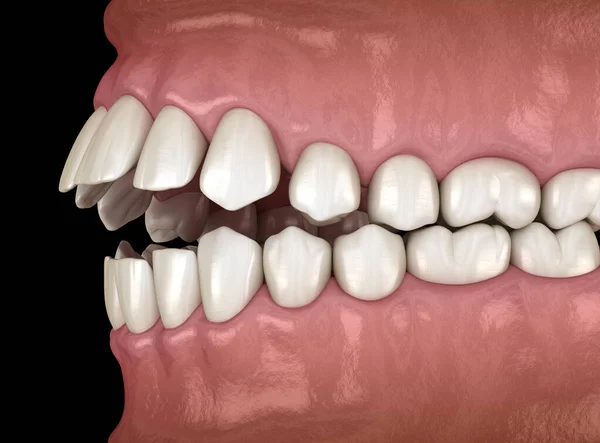 치아의 부정교합 의학적으로 스톡 사진