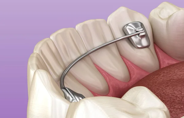 Зубний Протез Встановлений Після Лікування Брекетами Медично Точна Ілюстрація Стокова Картинка