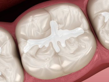 Molar Fissure diş dolguları. Diş 3B illüstrasyon