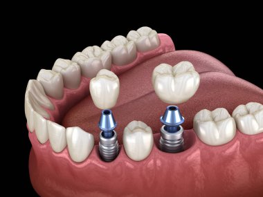 Azı dişi ve azı dişi yerleştirme implantın üzerine, vida saplantısı. Diş tedavisinin 3B illüstrasyonu
