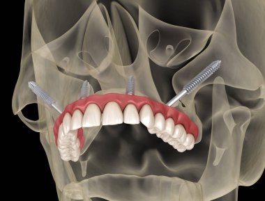 Elmacık kemiği implantları tarafından desteklenen Maxillary protezi. İnsan dişlerinin ve protezlerinin tıbbi açıdan doğru üç boyutlu çizimi