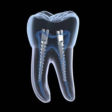 Azı dişlerinin içinde dişçi çeliği direği, röntgen görüntüsü. Diş içi endodontik tedavi 3 boyutlu illüstrasyon