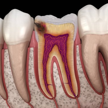 Hidden caries in to molar tooth. Medically accurate 3D illustration clipart